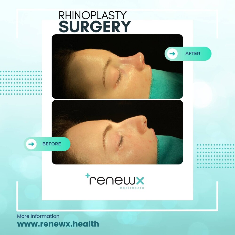 Before and After Result